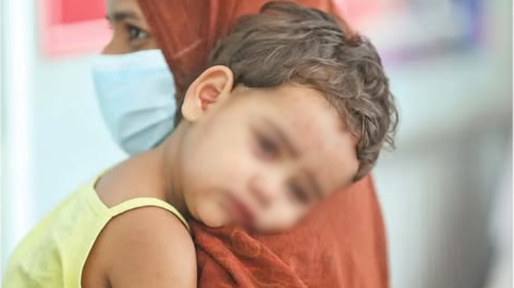 হাম প্রাদুর্ভাবে ১৬৯ শিশুর মৃত্যু, উদ্বেগজনক পরিস্থিতি